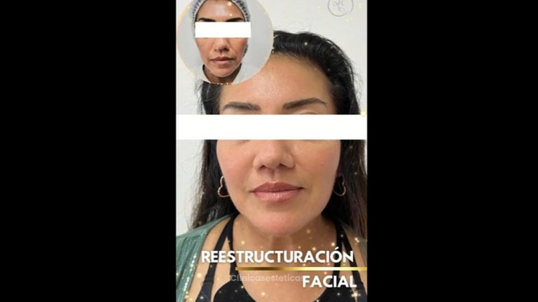 Restauración facial - Dra. Katherin Ruiz Márquez