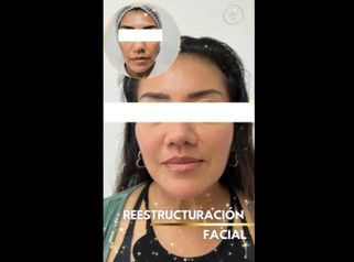 Restauración facial - Dra. Katherin Ruiz Márquez