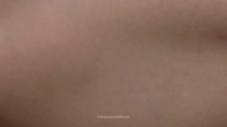 Braquioplastia - Dr. Nadir Carda