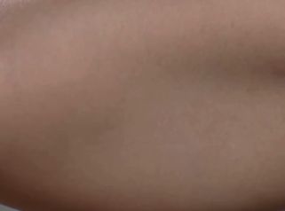Braquioplastia - Dr. Nadir Carda