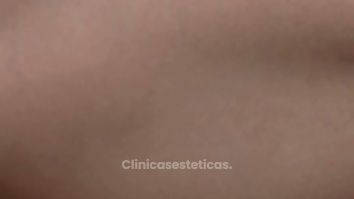 Braquioplastia - Dr. Nadir Carda
