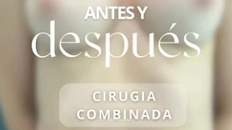 Abdominoplastia más aumento mamario - Dr. Vicente Sánchez Liberona