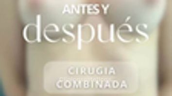 Abdominoplastia más aumento mamario - Dr. Vicente Sánchez Liberona