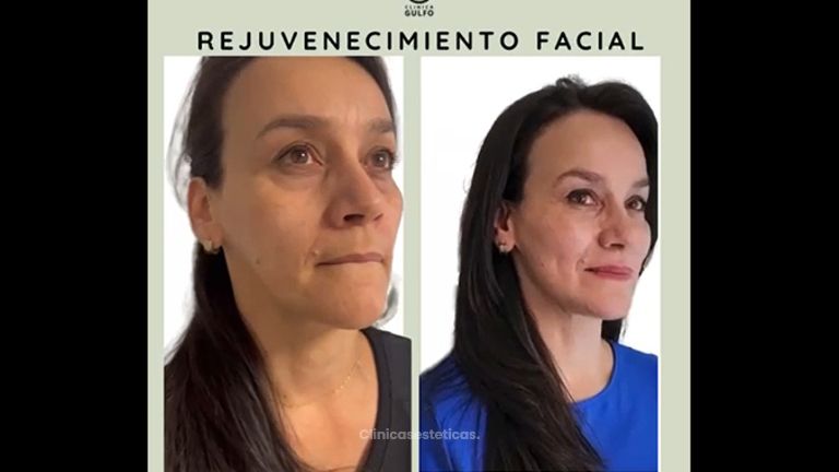 Rejuvemecimiento facial - Clínica Dra. Kelly Gulfo