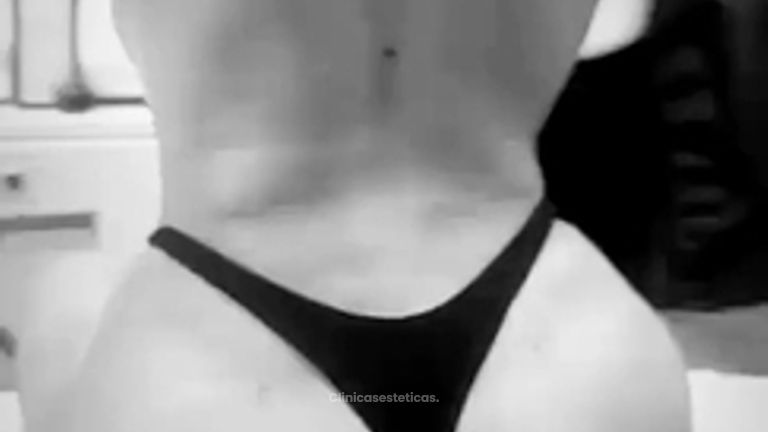 Lipoescultura más transferencia de grasa a glúteos - Dr. Guillermo Santana