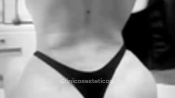 Lipoescultura más transferencia de grasa a glúteos - Dr. Guillermo Santana