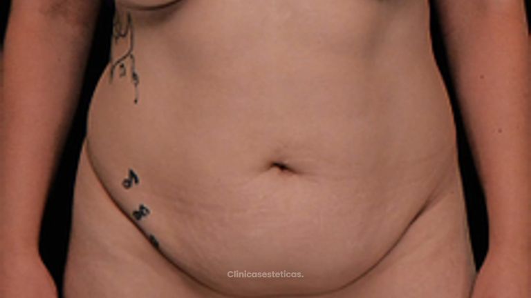Liposucción - Dr. Matías Kufeke
