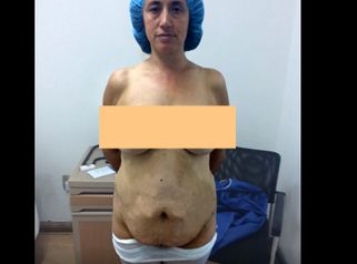 Lipoabdominoplastia