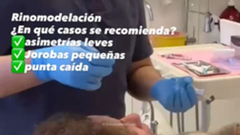 Rinomodelación con ácido hialurónico - Dr. Julio Vallejos