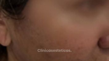 Lifting Facial - Dr. Sebastian Cosentino