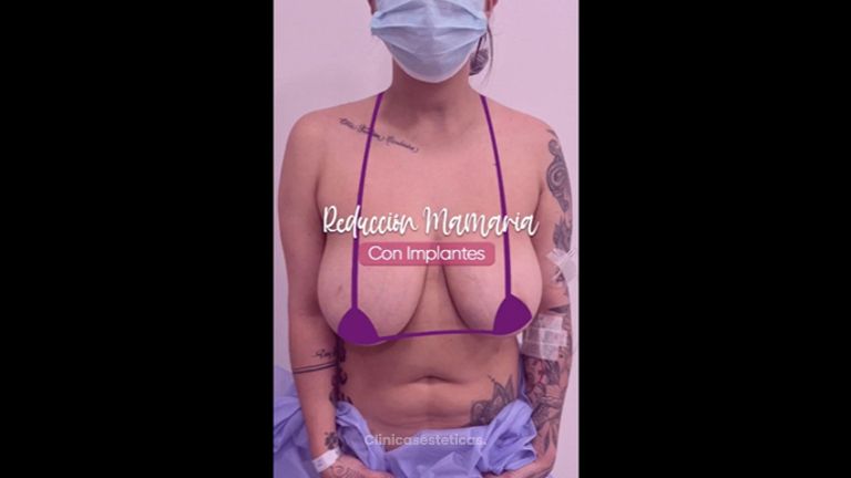 Reducción mamaria - Clínica Anastasia