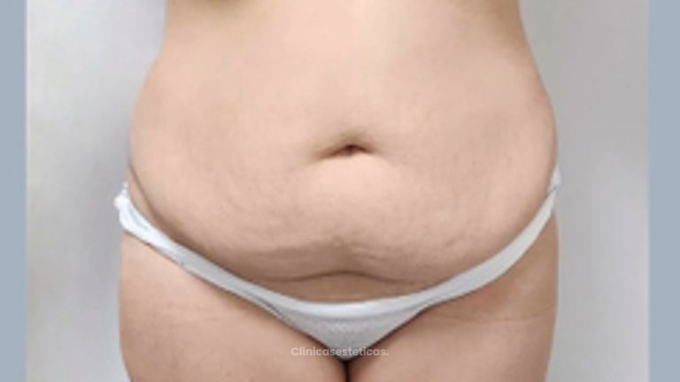 Lipoabdominoplastia - Dr. Nadir Carda