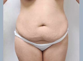 Lipoabdominoplastia - Dr. Nadir Carda