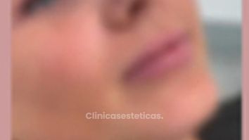 Aumento de labios - Eva Dermoestética