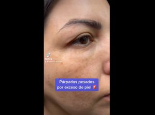 Blefaroplastia - Medicina Estética Integral MD