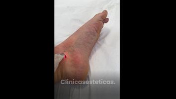 Tratamiento de varices