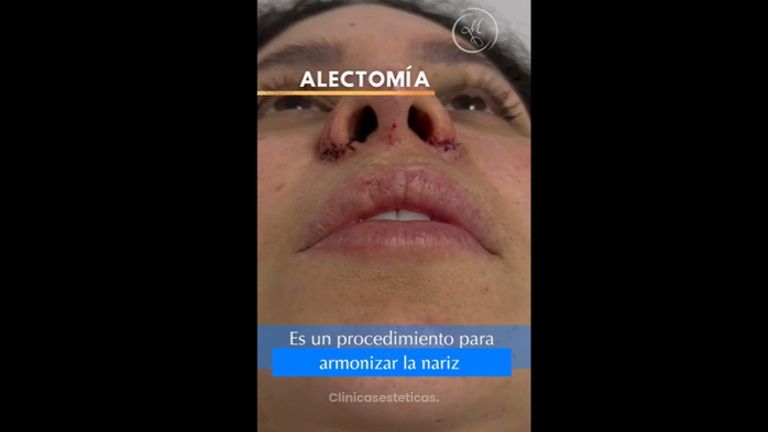 Alectomía - Dra. Katherin Ruiz Márquez