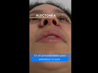 Alectomía - Dra. Katherin Ruiz Márquez