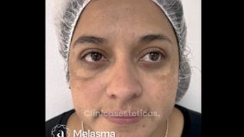 Melasma - Amanda Beauty