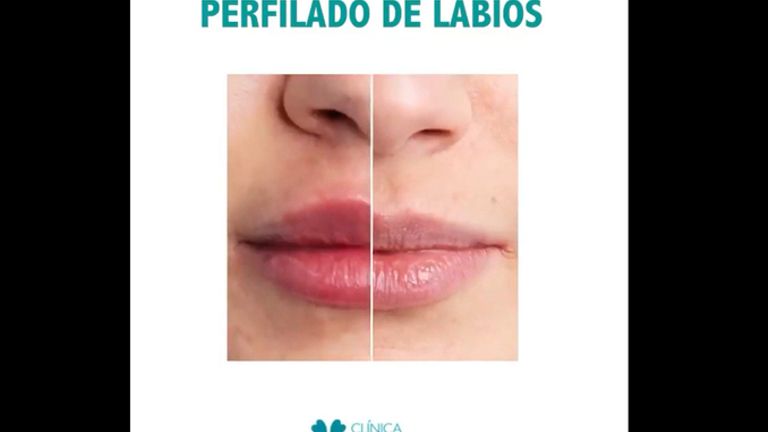 Aumento de labios - Clínica Doctor Flores Aqueveque