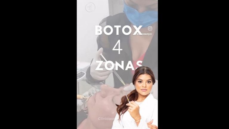 Botox 4 zonas - Dra. Katherin Ruiz Márquez