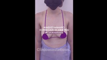 Aumento mamario - Clínica Anastasia