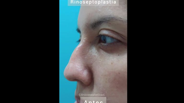Rinoplastia - Viveclinic