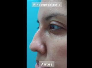 Rinoplastia - Viveclinic