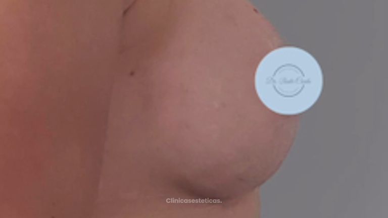 Aumento mamario - Dr. Nadir Carda