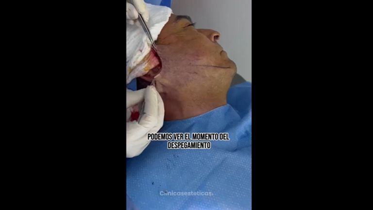 Lifting - Dr. Sebástian Cosentino