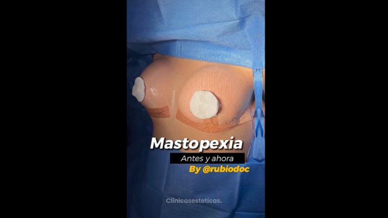 Mastopexia - Dr. Alvaro Rubio González