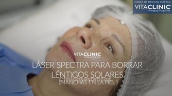 Láser Spectra para borrar léntigos solares - Vitaclinic