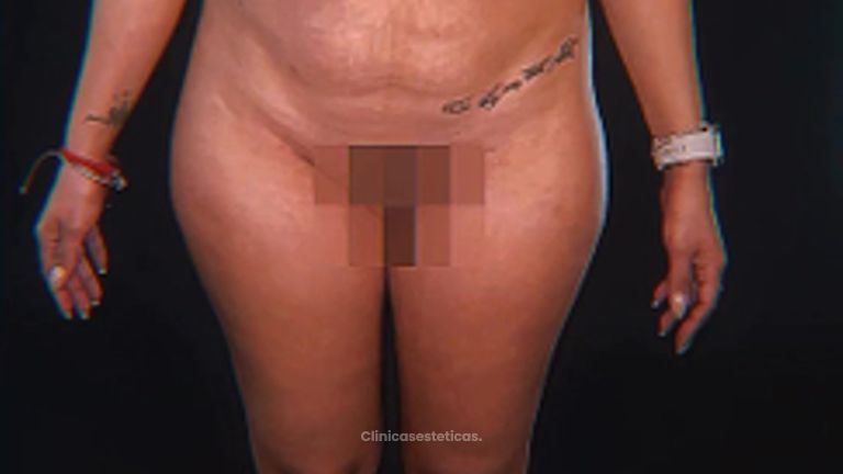Lipoescultura - Dr. Matías Kufeke
