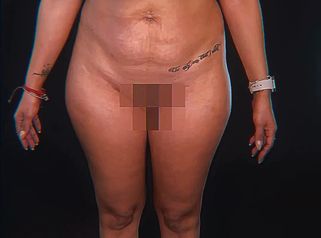 Lipoescultura - Dr. Matías Kufeke