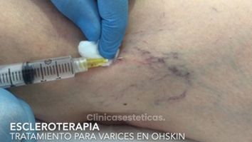 Tratamiento de varices