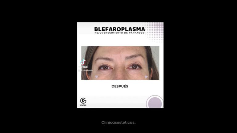 Blefaroplastia - Clínica Dra. Kelly Gulfo