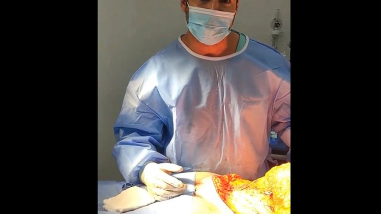 Abdominoplastia - Dr. Brian Frick 