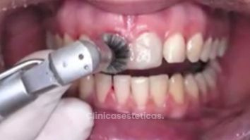 Consigue unos dientes más blancos