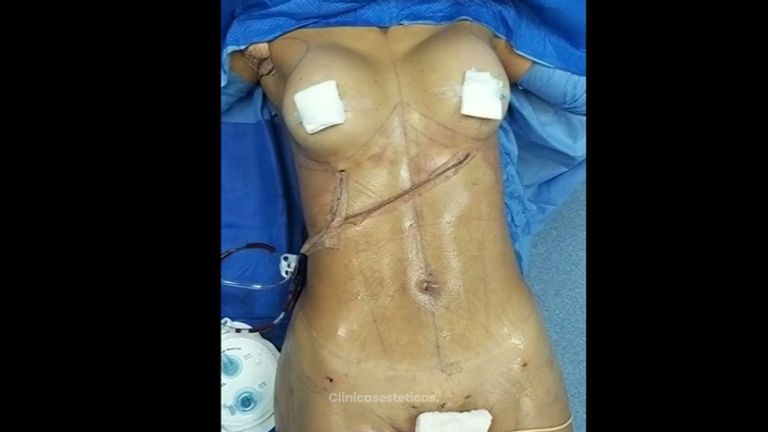 Lipo Clinic By Dr Puchi Clínica De Lipoescultura Hd
