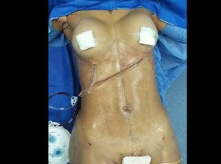 Lipo Clinic By Dr Puchi Clínica De Lipoescultura Hd