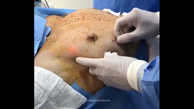 Ginecomastia - Medical Esthetic Co