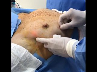 Ginecomastia - Medical Esthetic Co