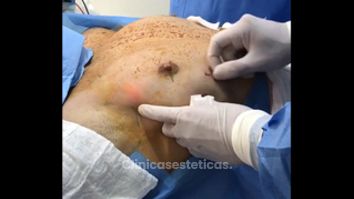 Ginecomastia - Medical Esthetic Co