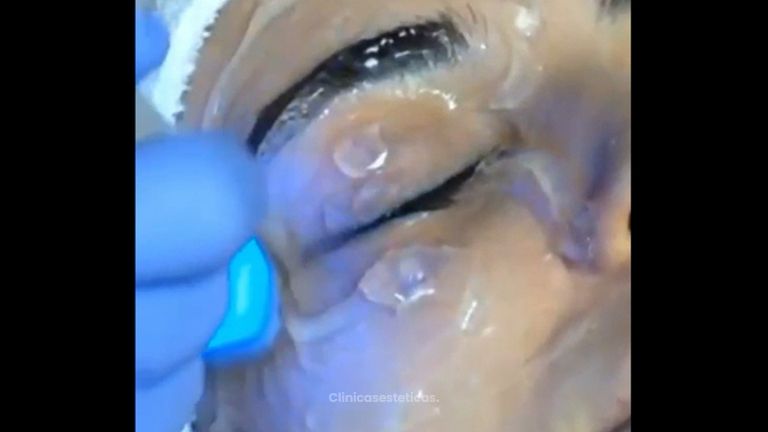 Rejuvenecimiento facial - Kinelawen