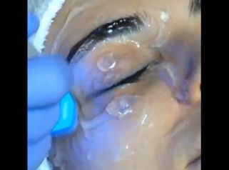 Rejuvenecimiento facial - Kinelawen