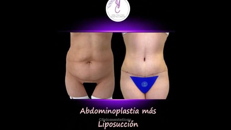 Abdominoplastia + Liposucción - Dra. Yelitza Castellanos
