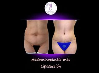 Abdominoplastia + Liposucción - Dra. Yelitza Castellanos