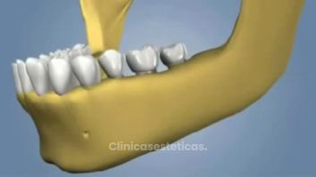 Ponte implantes y luce tu mejor sonrisa