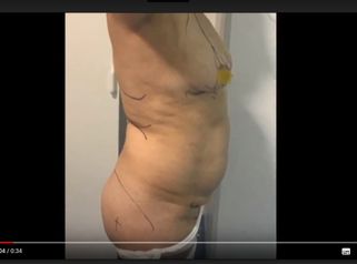 Lipoescultura+Aumento de Gluteos