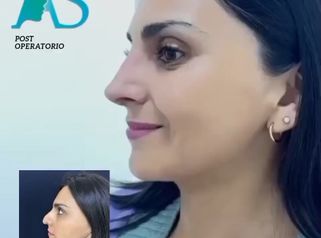 Rinoplastia - Dra. Angélica Sifontes Muñoz